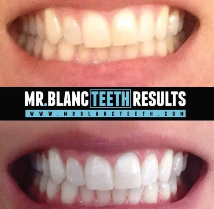 MrBlancTeeth hambavalgenduse ribad